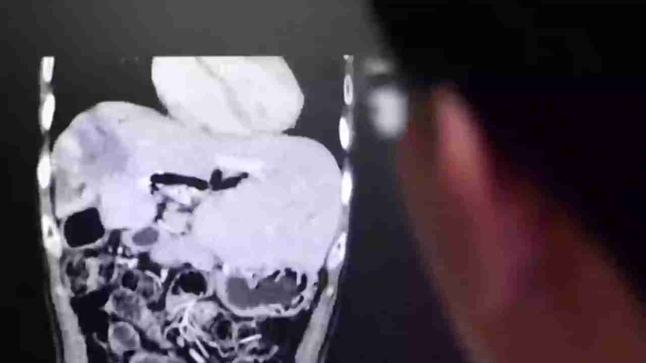 Viral: నోరూరించే పచ్చి చేపల కూర.. కడుపులో మంటతో ఆస్పత్రికి పరుగులు.. ఎక్స్‌రే తీయగా