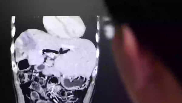 Viral: నోరూరించే పచ్చి చేపల కూర.. కడుపులో మంటతో ఆస్పత్రికి పరుగులు.. ఎక్స్రే తీయగా