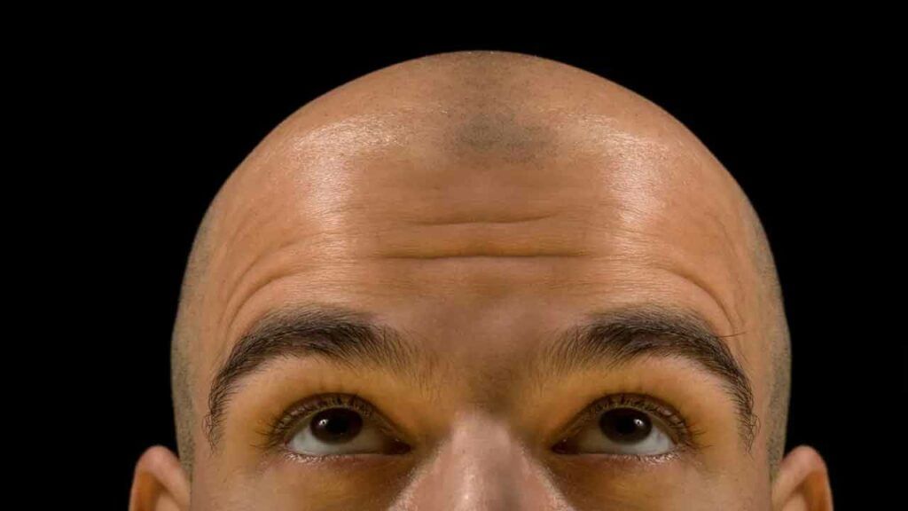 Bald Head In Men