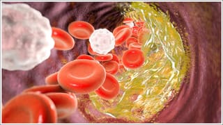 Home Remedies: చెవిలో గులిమి ఇయర్ బర్డ్స్‌తో శుభ్రం చేస్తున్నారా? జాగ్రత్త అసలుకే ఎసరు..