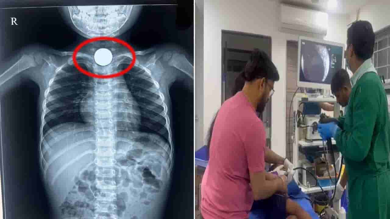 Telangana: ఐదు రూపాయల కాయిన్ మింగిన నాలుగేళ్ల చిన్నారి.. గొంతులో ఇరుక్కోవడంతో..!