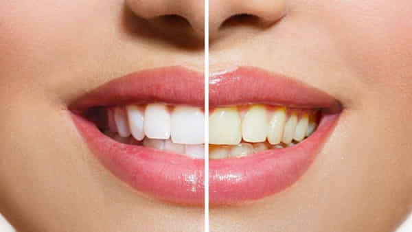 Dental Care: పసుపు మరకలు తొలగించి పళ్లను తెల్లగా మెరిపించాలంటే.. ఈ సింపుల్ రెమిడీస్ ట్రై చేయండి
