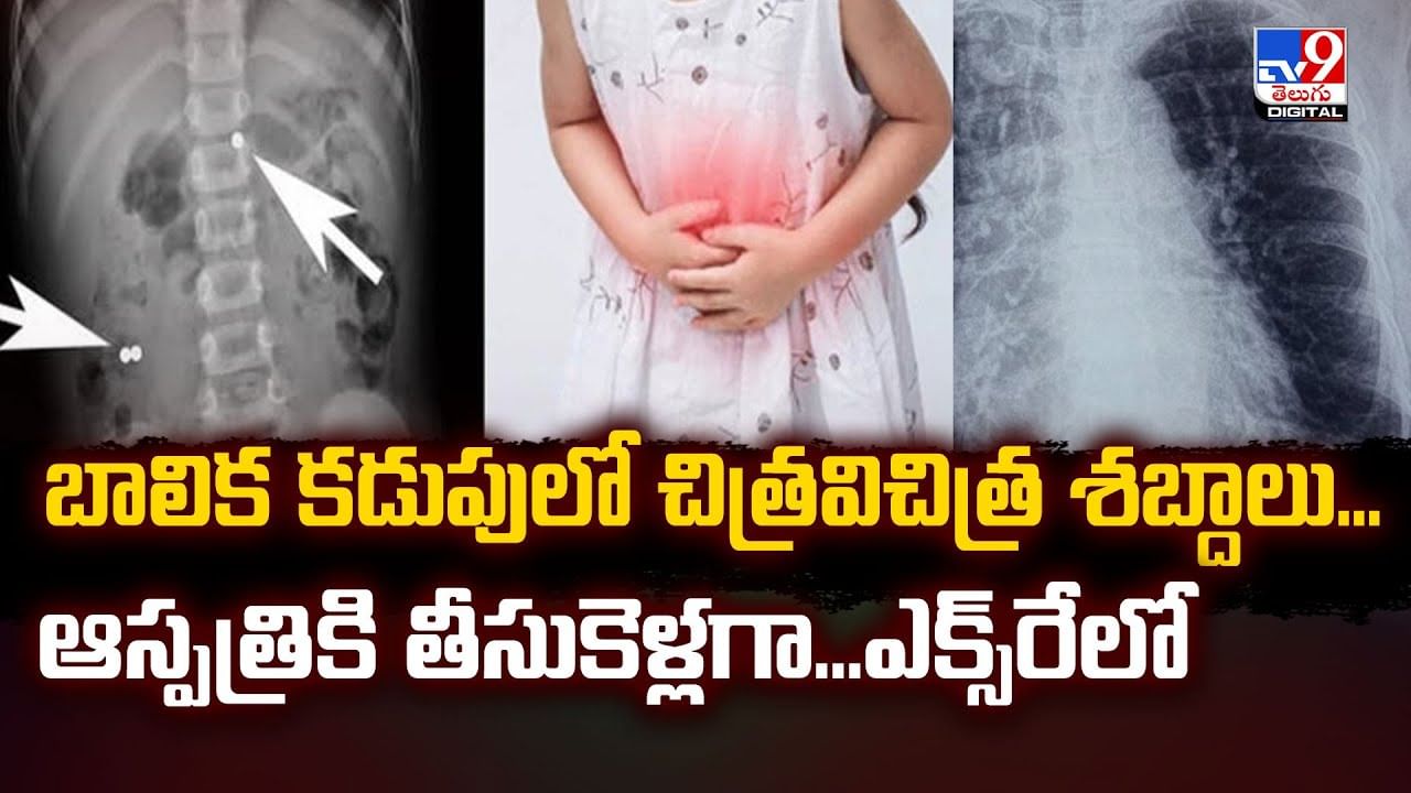 బాలిక కడుపులో చిత్రవిచిత్ర శబ్దాలు...ఆస్పత్రికి తీసుకెళ్లగా... ఎక్స్‌రేలో