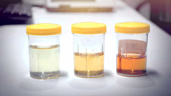 Urine Color: మూత్రం రంగును బట్టి ఆరోగ్య సమస్యలు చెప్పొచ్చు.. ఏ రంగు ఏ వ్యాధిని సూచిస్తుందో తెలుసుకోండి..