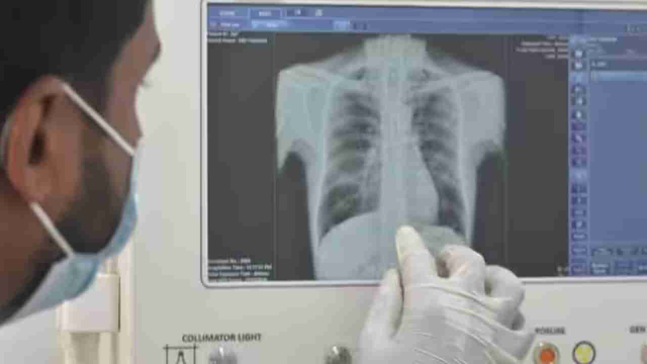 టీబీ గుర్తింపులో ఏఐ విప్లవం.. చెస్ట్ ఎక్స్‌రే ఒక్కటి చాలు.. టీబీ ఉందో లేదో తెలిసిపోతుంది..!