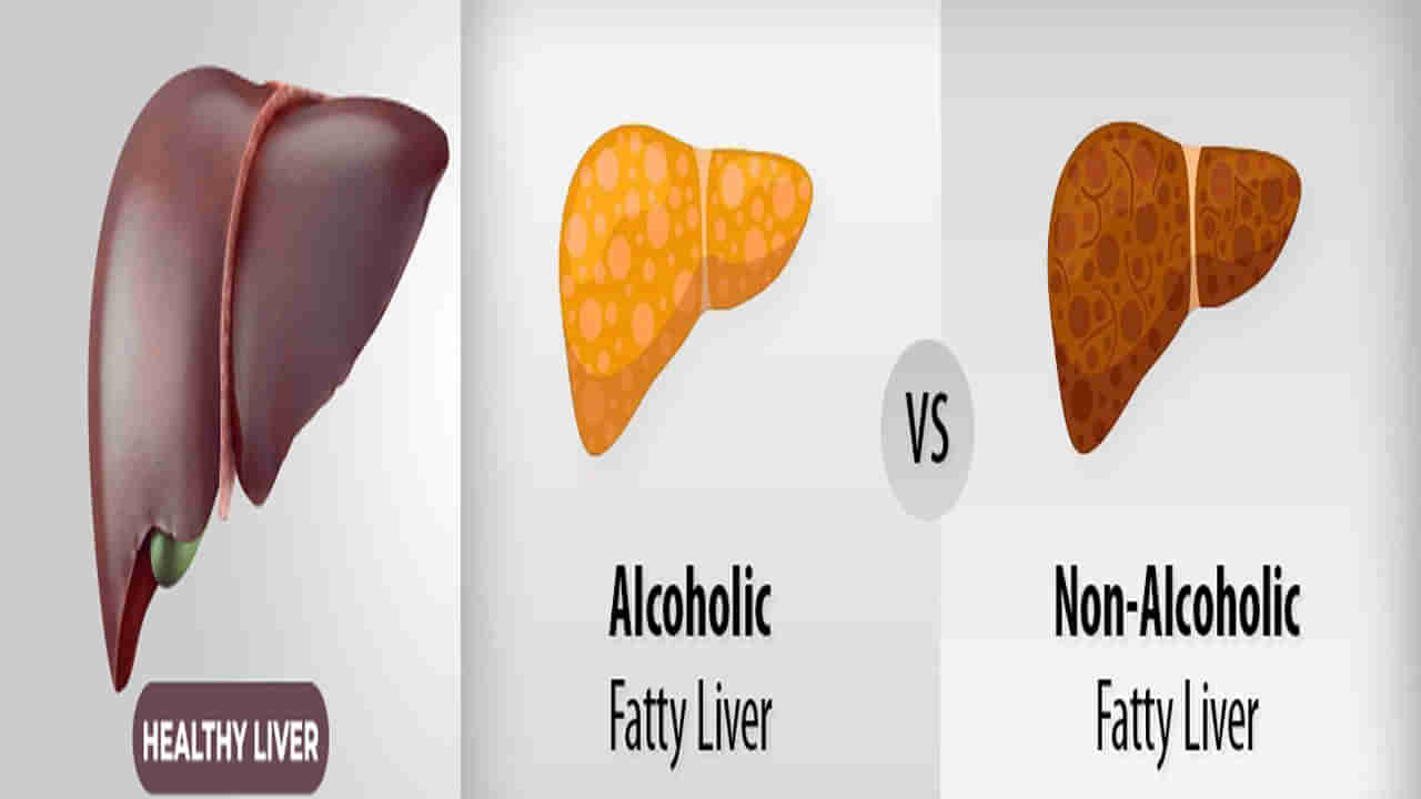 Fatty Liver Disease: ఆల్కహాలిక్ లేదా నాన్ ఆల్కహాలిక్ ఫ్యాటీ లివర్ వ్యాధి.. రెండిటిలో ఏది ప్రమాదకరం.. నిపుణుల సలహా ఏమిటంటే..