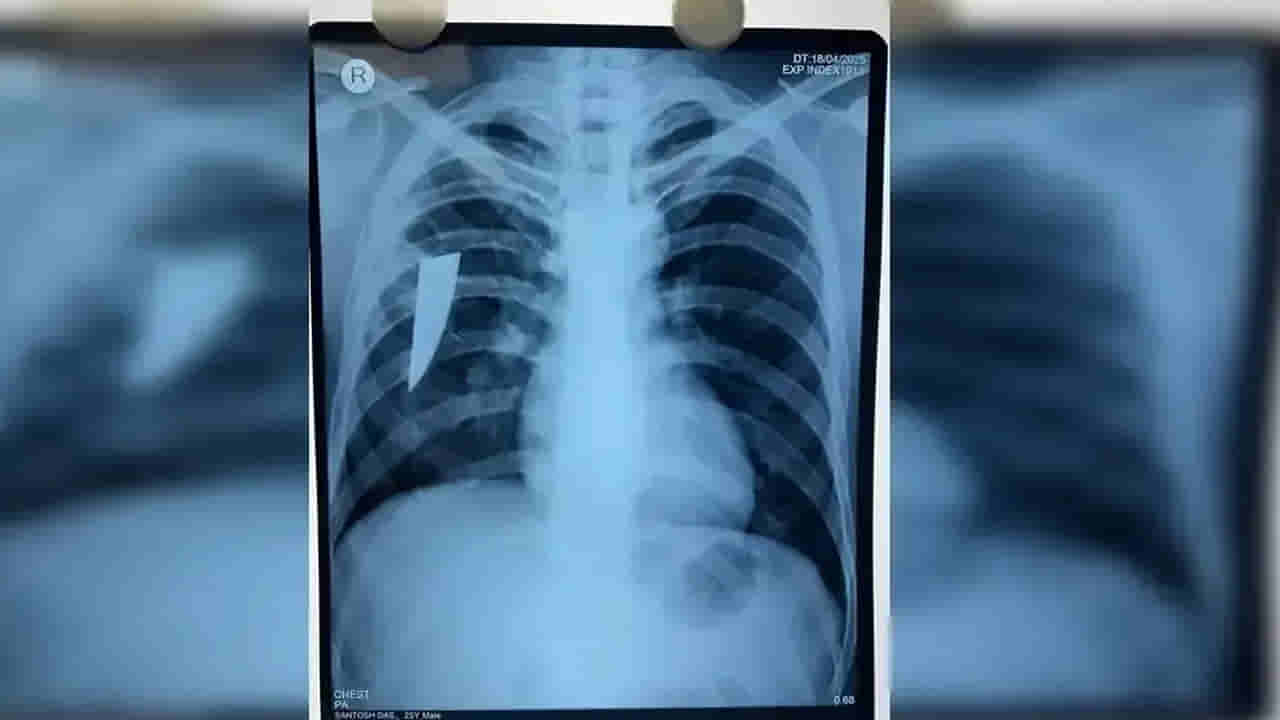 Viral: దగ్గినప్పుడల్లా రక్తం.. ఆస్పత్రికి తీసుకెళ్లగా.. ఎక్స్ రే తీసి స్టన్ అయిన వైద్యులు