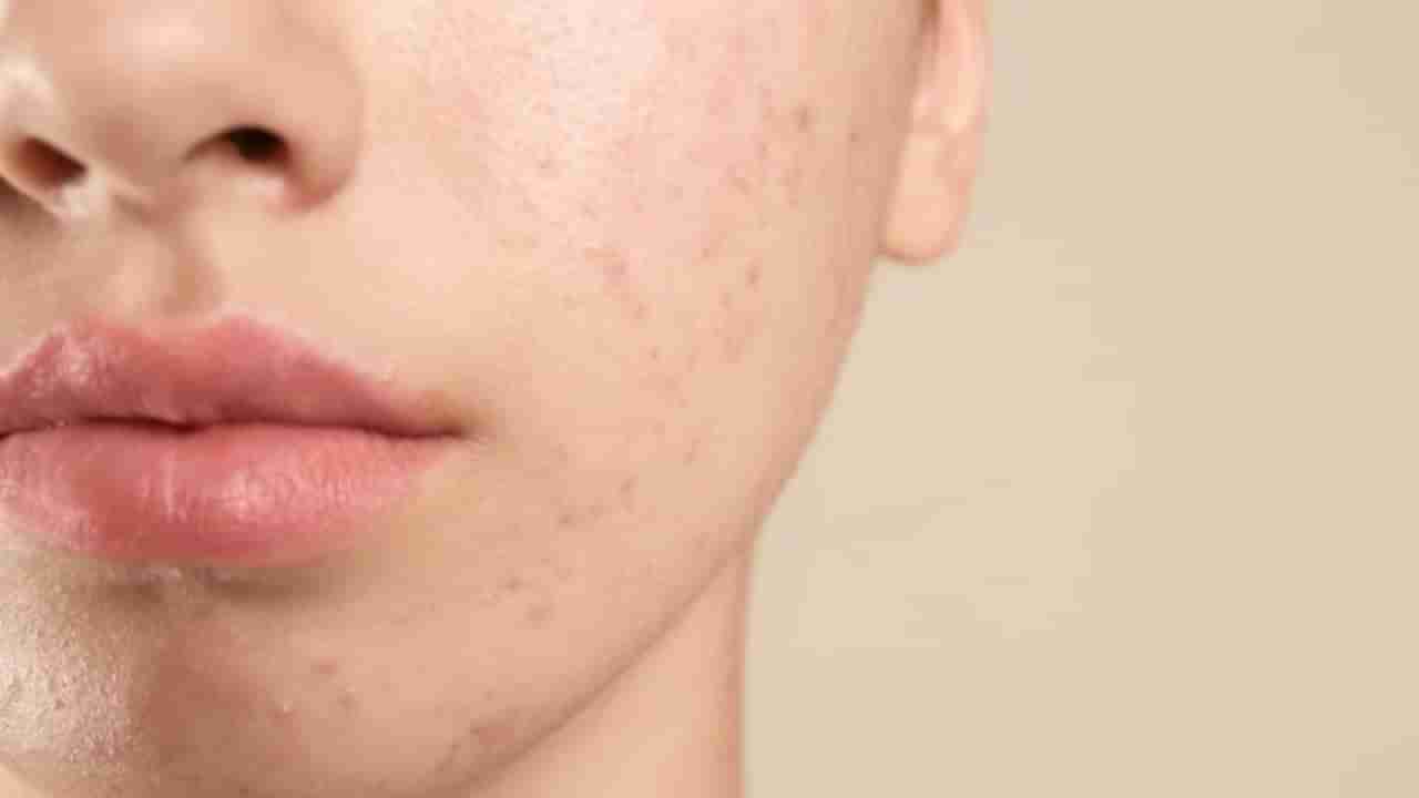 మహిళల్లో మొటిమలు ఎలా వస్తాయో తెలుసా..? షాకింగ్ విషయాలు మీకోసం..!