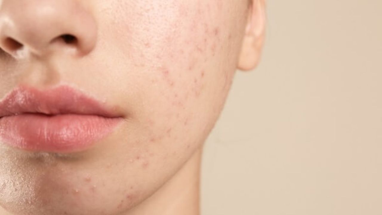 మహిళల్లో మొటిమలు ఎలా వస్తాయో తెలుసా..? షాకింగ్ విషయాలు మీకోసం..!