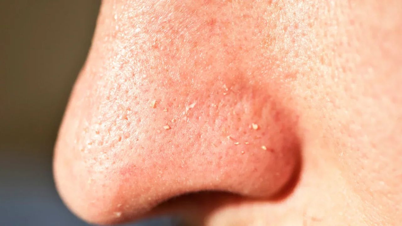 ముక్కు మీద వైట్ హెడ్స్ తోని ఇబ్బంది పడుతున్నారా..? 10 నిమిషాల్లోనే ఇలా మాయం చేయండి..!