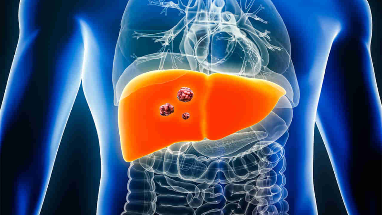 Liver Cancer: సైలెంట్గా విజృంభిస్తున్న లివర్ క్యాన్సర్.. ఈ 3 అలవాట్లు మీకుంటే ఇప్పుడే మానుకోండి..
