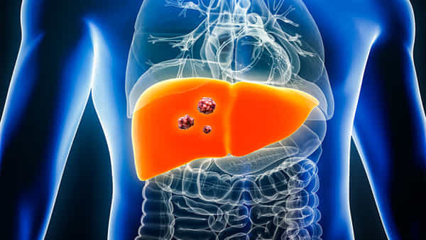 Liver Cancer: సైలెంట్గా విజృంభిస్తున్న లివర్ క్యాన్సర్.. ఈ 3 అలవాట్లు మీకుంటే ఇప్పుడే మానుకోండి..