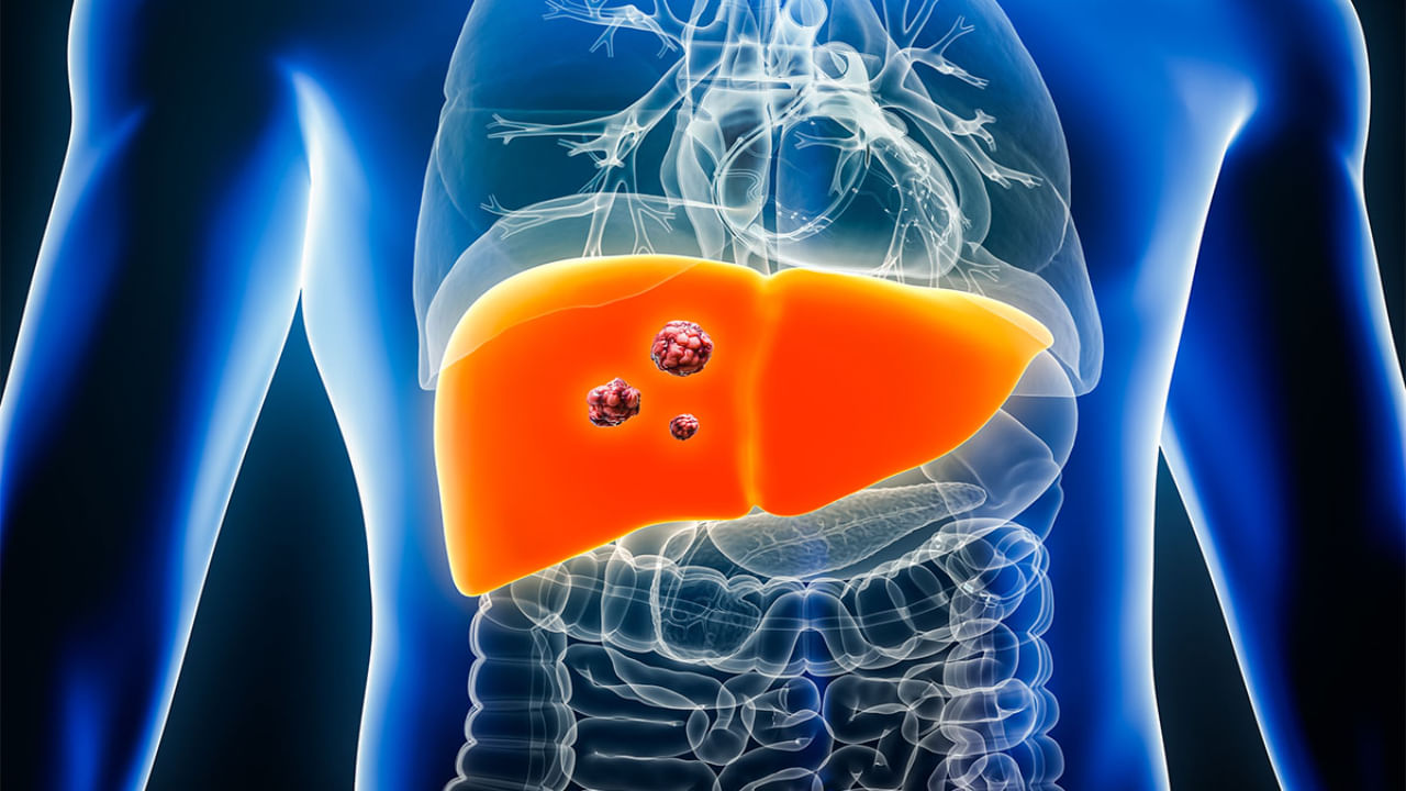 Liver Cancer: సైలెంట్గా విజృంభిస్తున్న లివర్ క్యాన్సర్.. ఈ 3 అలవాట్లు మీకుంటే ఇప్పుడే మానుకోండి..