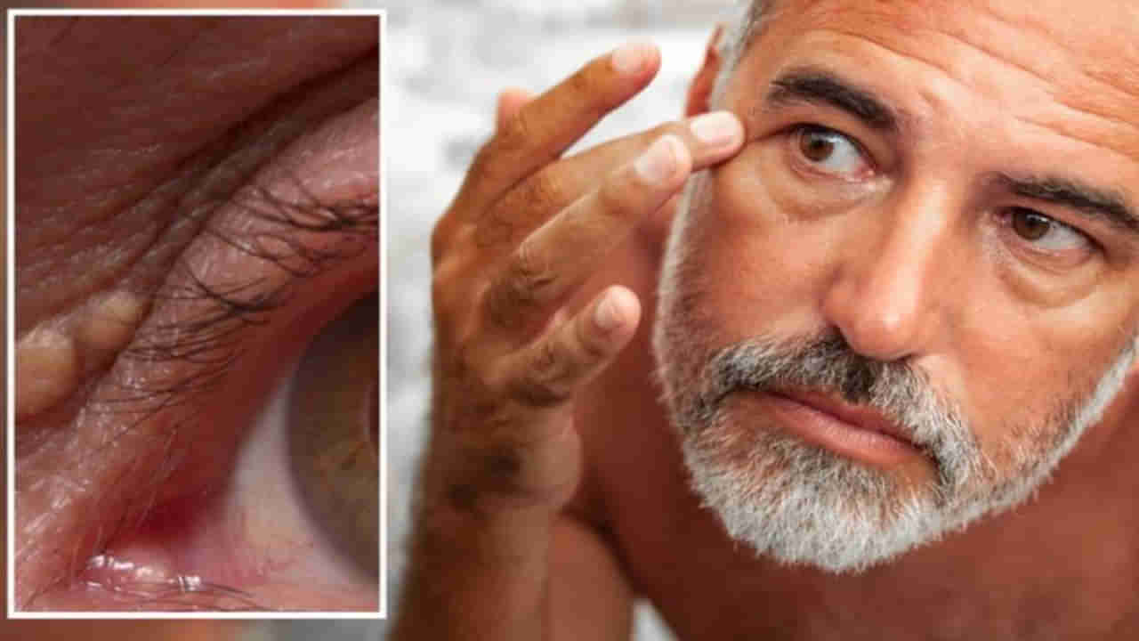 Cholesterol: చెడు కొలెస్ట్రాల్ పెరిగిపోతున్నాయని తెలిపే సంకేతాలివి.. ముఖంపై ఈ లక్షణాలుంటే వెంటనే అలర్టవ్వండి..