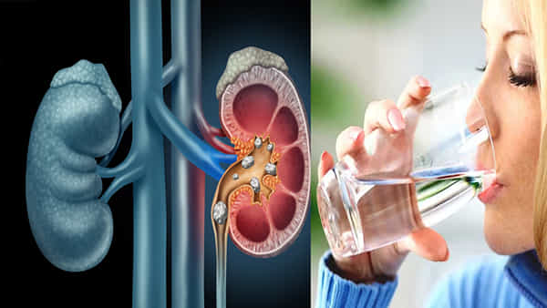 Kidney Stones: కిడ్నీలో రాళ్ళు ఎందుకు వస్తాయి? దీనిని నివారించవచ్చా? డాక్టర్ సలహా ఏమిటంటే