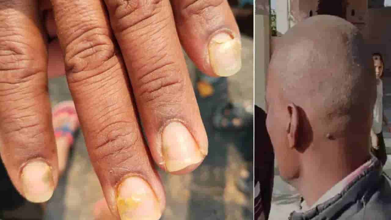 బాబోయ్ ఆ గ్రామాలకు ఇదేం శాపం.. అప్పుడు జుట్టు రాలింది.. ఇప్పుడు గోళ్లు ఊడిపోతున్నాయ్.. భయం గుప్పిట్లో..