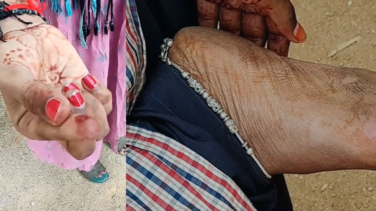 Anantapur: రాత్రి హాస్టల్ గదుల్లో నిద్రపోయిన విద్యార్థినులు.. పొద్దున లేచేసరికి కాళ్లు, చేతులకు...