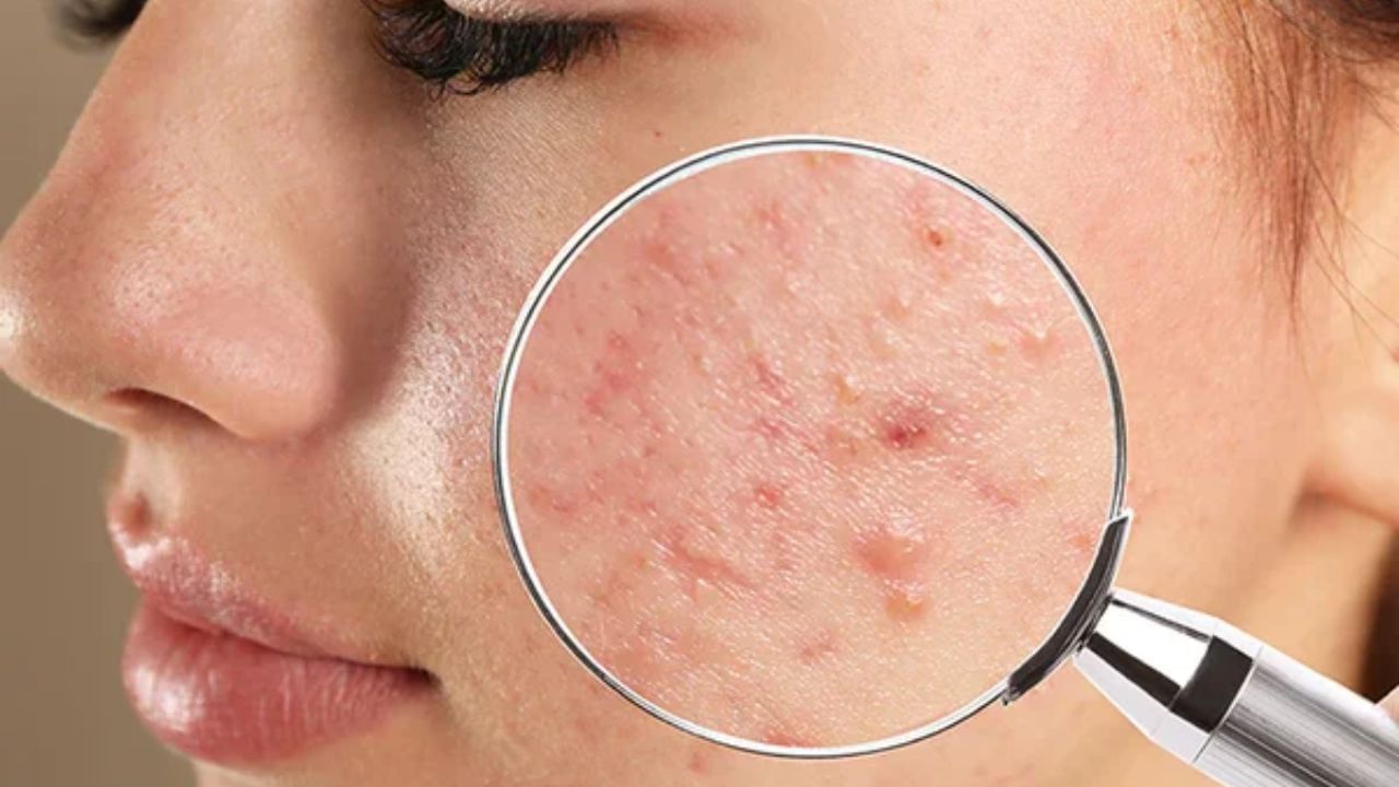 మొఖం మీద మొటిమలు తగ్గాలంటే ఫస్ట్ ఇవి తినడం మానేయండి.. లేదంటే ఇంకా ఎక్కువగా అవుతాయి..!