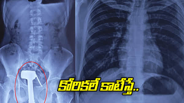 Viral: కోరికలే కాటేస్తే.. పేట్రేగిపోయి ప్రైవేట్ పార్టులోకి.. ఎక్స్రే చూసి కంగుతిన్న డాక్టర్లు