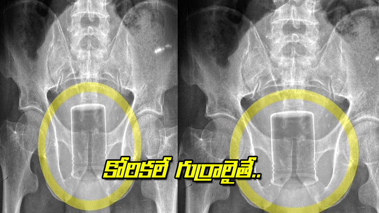 Viral: కోరికలే గుర్రాలైతే.. కక్కుర్తిపడి ప్రైవేటు పార్టులోకి.. ఎక్స్రే తీసి బిత్తరపోయిన డాక్టర్లు