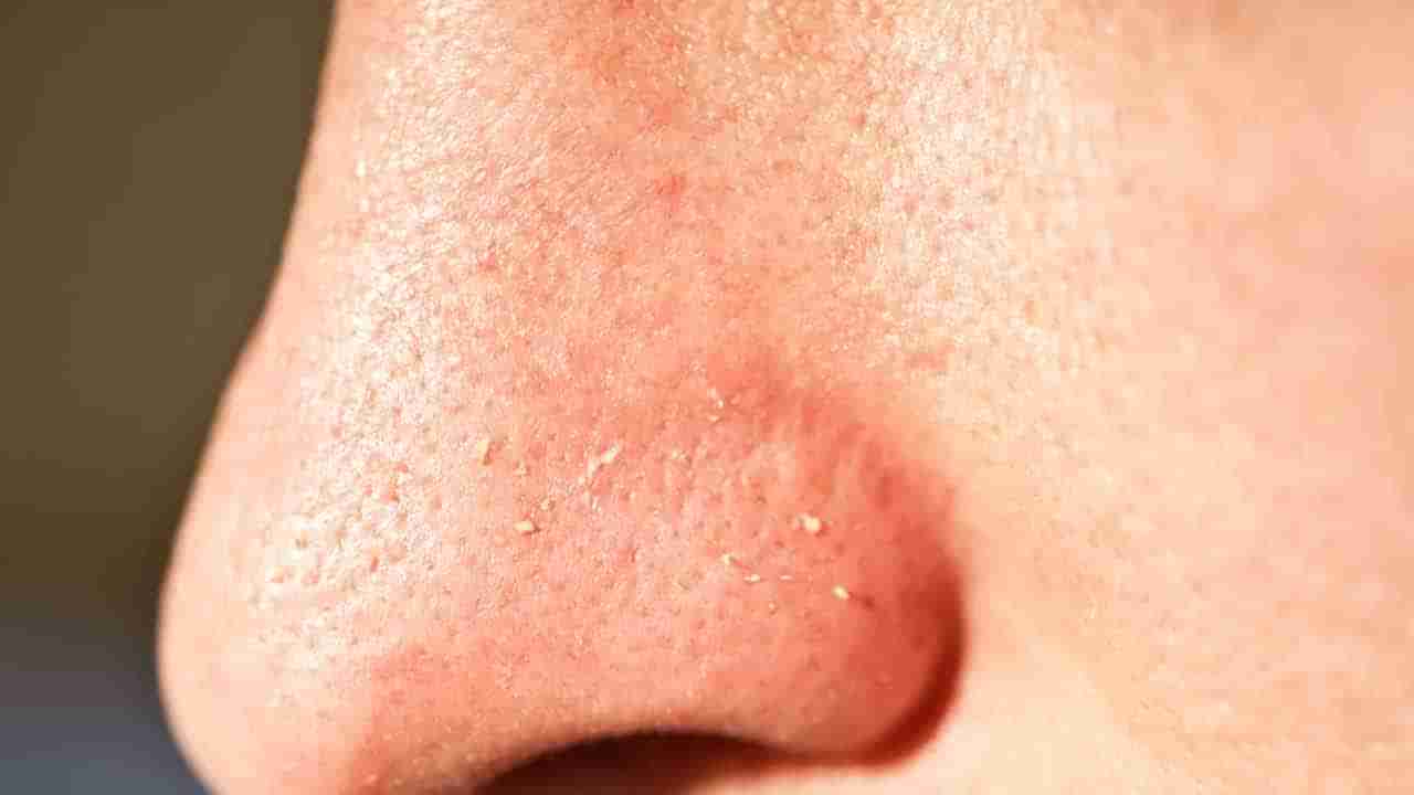 ముక్కు మీద వైట్ హెడ్స్‌తో ఇబ్బంది పడుతున్నారా..? ఈ టిప్స్‌ ట్రై చేయండి..10నిమిషాల్లో మటుమాయం!