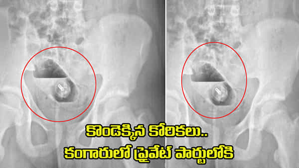 Viral: కొండెక్కిన కోరికలు.. కంగారులో ప్రైవేట్ పార్టులోకి.. ఆపై ఎక్సరే తీయగా..