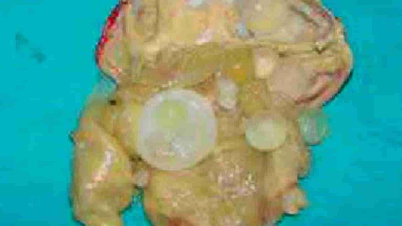 Guntur: 2 నెలలుగా తగ్గని కడుపునొప్పి.. గుంటూరు ఆస్పత్రిలో అసలు విషయం తేలింది..