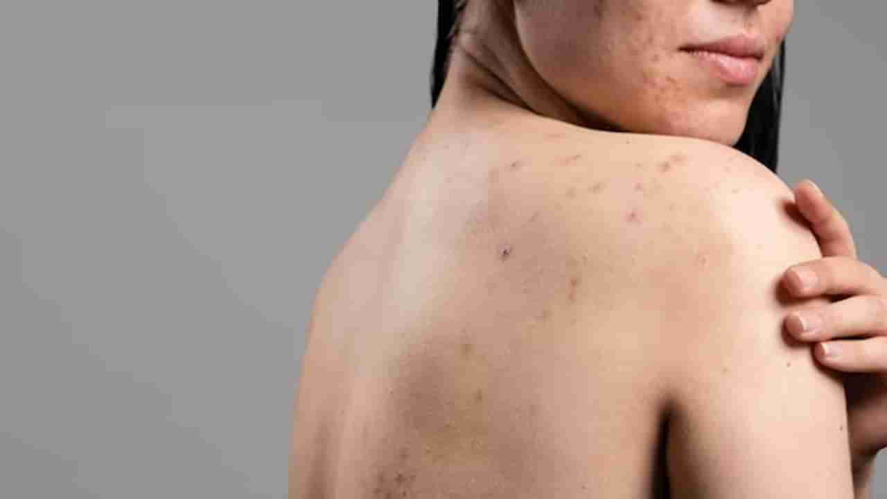 Body Acne: వారానికి రెండుసార్లు ఇలా చేయండి.. మీ చర్మం మెరుస్తుంది..!