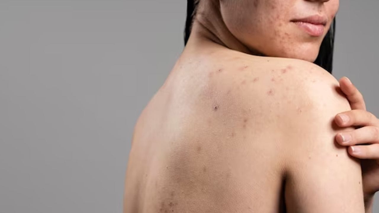 Body Acne: వారానికి రెండుసార్లు ఇలా చేయండి.. మీ చర్మం మెరుస్తుంది..!