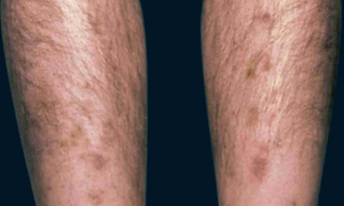 Diabetes: చర్మంపై ఇలాంటి మార్పులు కనిపిస్తున్నాయా.. వెంటనే వైద్యుడిని సంప్రదించండి..