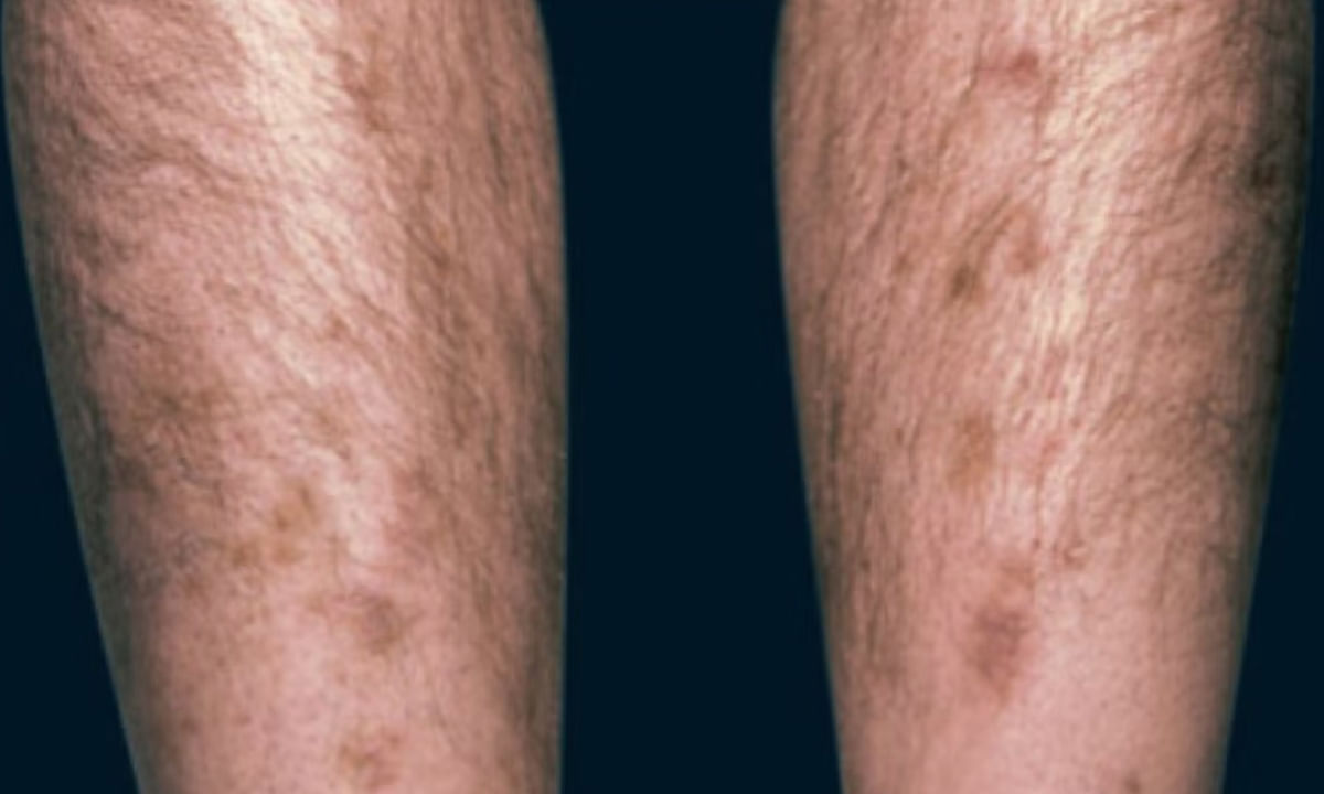 Diabetes: చర్మంపై ఇలాంటి మార్పులు కనిపిస్తున్నాయా.. వెంటనే వైద్యుడిని సంప్రదించండి..