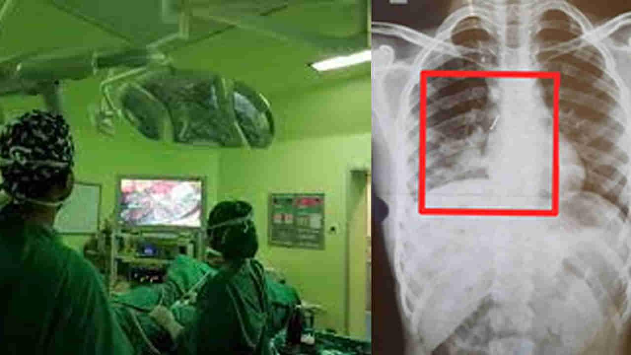 Viral: 12 ఏళ్ల బాలుడికి శ్వాస తీసుకోవడంలో ఇబ్బంది.. ఆస్పత్రిలో CT స్కాన్ తీసిన వైద్యులు షాక్