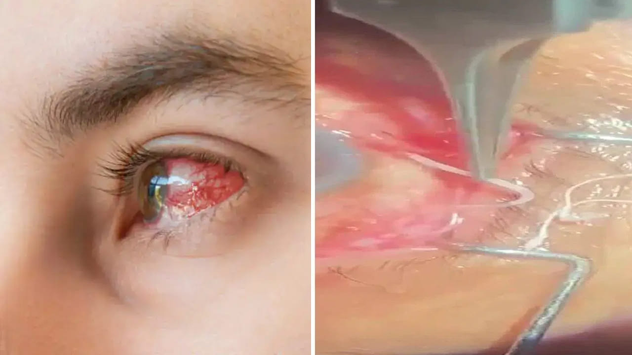 Viral: కంటిలో ఏదో గుచ్చుతున్నట్టు అనిపించింది.. నొప్పితో పరుగున ఆస్పత్రికి వెళ్లగా