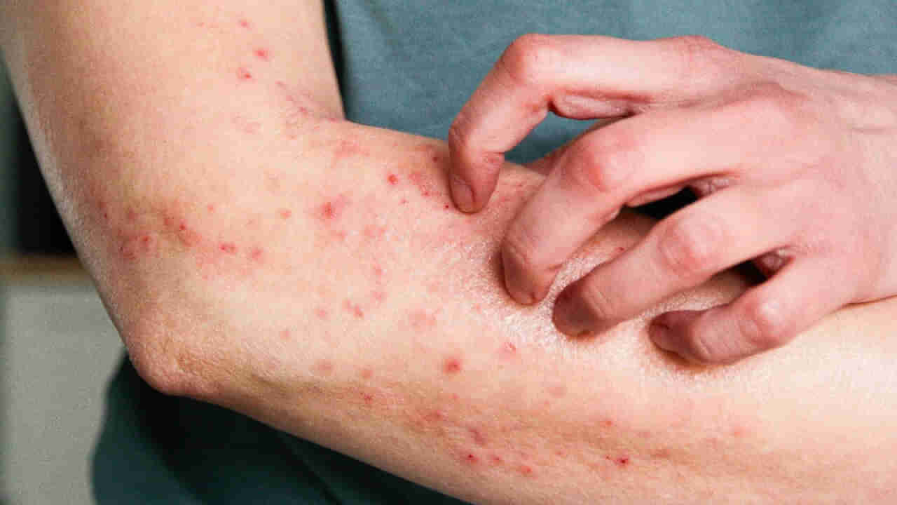 వాతావరణ మార్పులతో భయంకరమైన ఫంగల్‌ ఇన్ఫెక్షన్లు! వణుకు పుట్టిస్తున్న అధ్యాయనం