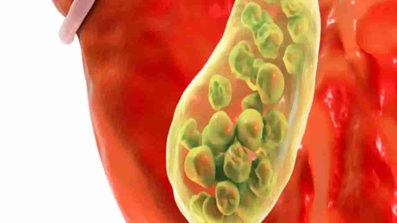 మనం చేసే తప్పులతోనే పెను ప్రమాదం.. పిత్తాశయంలో రాళ్ళు ఎందుకు ఏర్పడతాయో తెలుసా..?