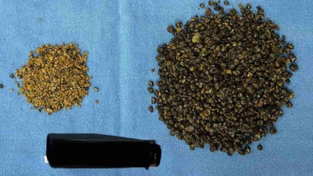 Viral News: 70 ఏళ్ల వ్యక్తి గాల్ బ్లాడర్‌ లో  8,125 రాళ్లు...! లెక్కపెట్టడానికే 6 గంటలు పట్టింది