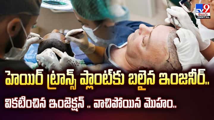 హెయిర్ ట్రాన్స్ ప్లాంట్కు బలైన ఇంజనీర్.. వికటించిన ఇంజెక్షన్.. వాచిపోయిన మొహం.. వీడియో హెయిర్ ట్రాన్స్ ప్లాంట్కు బలైన ఇంజనీర్.. వికటించిన ఇంజెక్షన్.. వాచిపోయిన మొహం.. వీడియో