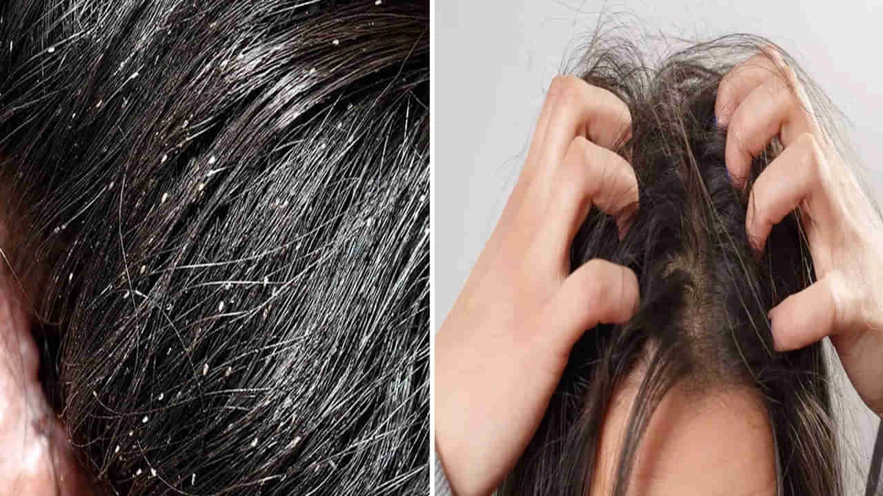 Home Remedies: పేలు, ఈపెలు సమస్యతో ఇబ్బంది పడుతున్నారా.. ఈ వంటింటి చిట్కాతో చెక్ పెట్టండి..