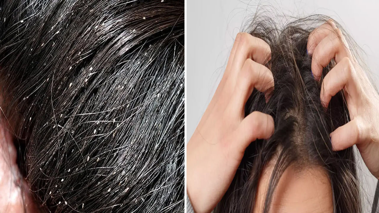 Home Remedies: పేలు, ఈపెలు సమస్యతో ఇబ్బంది పడుతున్నారా.. ఈ వంటింటి చిట్కాతో చెక్ పెట్టండి..