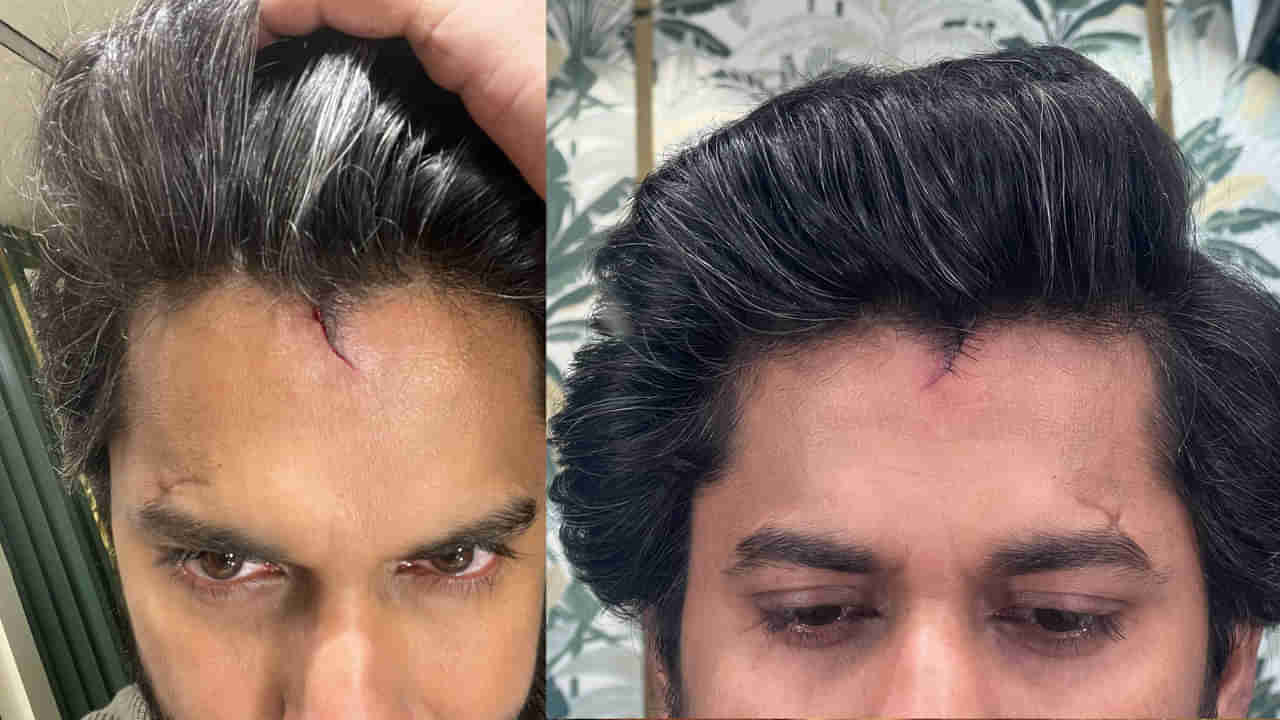 తల పగిలి కుట్లు పడ్డాయి.. అయినా షూటింగ్ ఆపలేదు..! కట్ చేస్తే భారీ హిట్.. ఈ హీరో ఎవరో తెలుసా..?