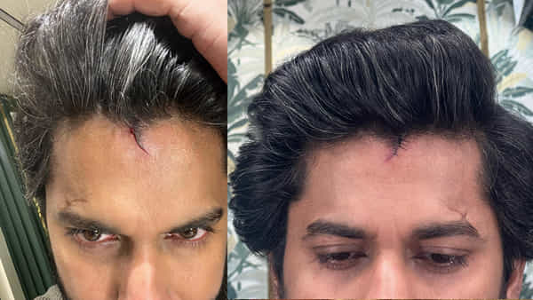 తల పగిలి కుట్లు పడ్డాయి.. అయినా షూటింగ్ ఆపలేదు..! కట్ చేస్తే భారీ హిట్.. ఈ హీరో ఎవరో తెలుసా..?