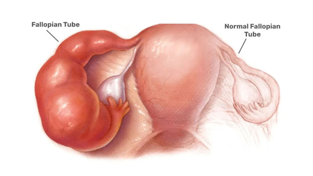 హైడ్రోసాల్పిన్క్స్ చికిత్సకు లాపరోస్కోపీ, IVF విధానాలు ప్రస్తుతం అందుబాటులో ఉన్నాయి. మూత్ర విసర్జన సమయంలో మంట, ఋతుస్రావం సమయంలో నొప్పి ఇవన్నీ హైడ్రోసాల్పింక్స్ లక్షణాలు. ఫెలోపియన్ నాళాలలో ఇన్ఫెక్షన్ ఉండి, ఉదరం ఉబ్బితే మహిళల గర్భాశయంలో సమస్యలు ఉన్నట్లే.