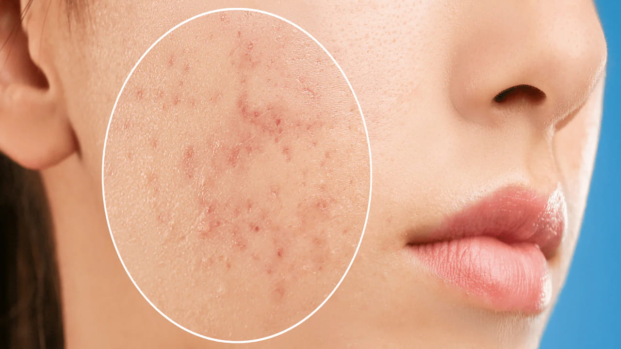 మొటిమ గిల్లితే మొదటికే మోసం.. మెదడుకు ఇన్ఫెక్షన్ సోకి పక్షవాతం.. చివరికి ఇలా.. !