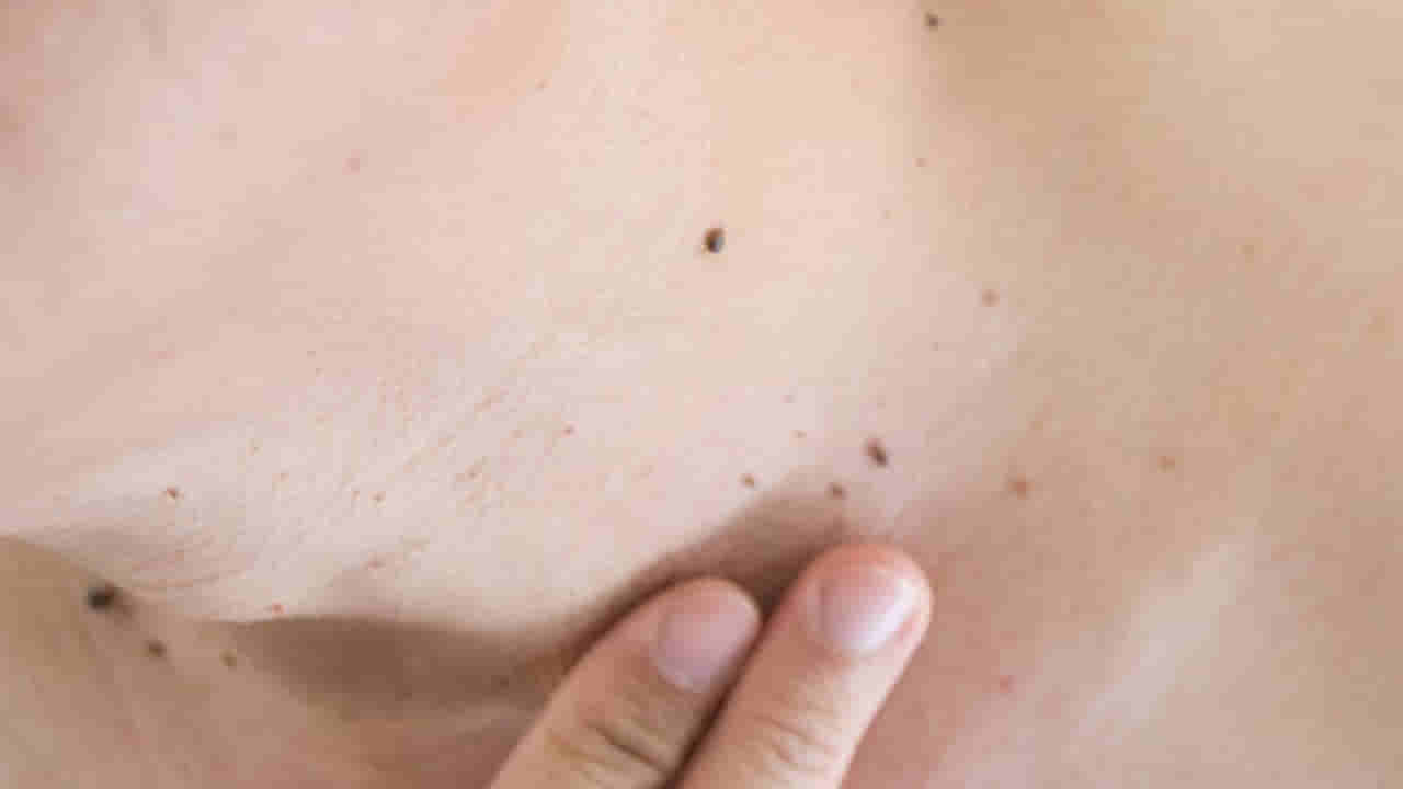 పులిపిర్లతో ఇబ్బంది పడుతున్నారా.. అయితే ఈ చిట్కాలు పాటించండి!