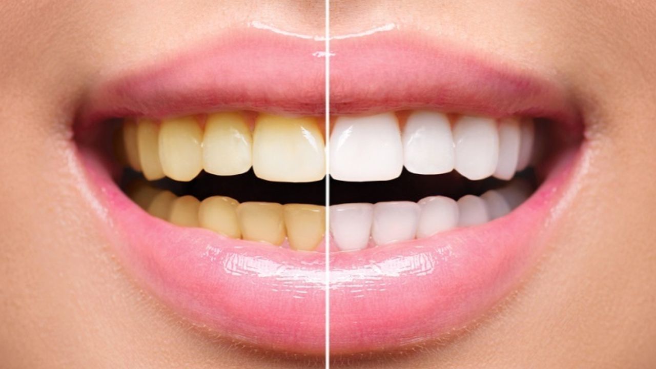 పళ్లు పసుపు రంగులో ఉండి ఇబ్బందిగా ఉందా..? ఇలా చేయండి.. మంచి రిజల్ట్ ఉంటుంది..!