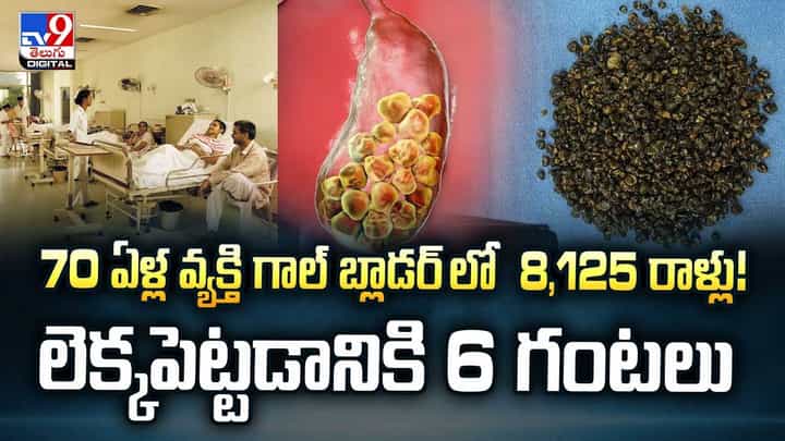 70 ఏళ్ల వ్యక్తి గాల్ బ్లాడర్ లో 8,125 రాళ్లు! లెక్కపెట్టడానికి 6 గంటలు వీడియో 70 ఏళ్ల వ్యక్తి గాల్ బ్లాడర్ లో 8,125 రాళ్లు! లెక్కపెట్టడానికి 6 గంటలు వీడియో