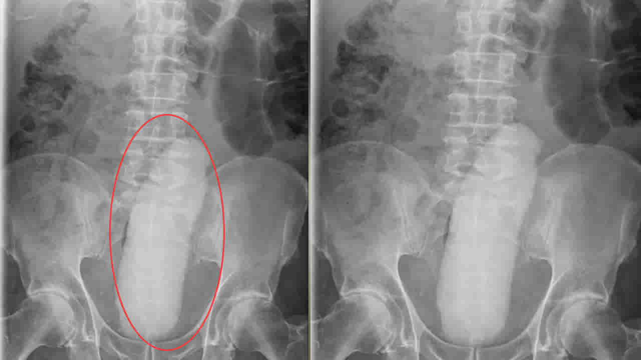 Viral: ప్రైవేట్ పార్టులో తీవ్రమైన నొప్పి.. పరుగు పరుగున ఆస్పత్రికి.. డాక్టర్లు టెస్టులు చేయగా