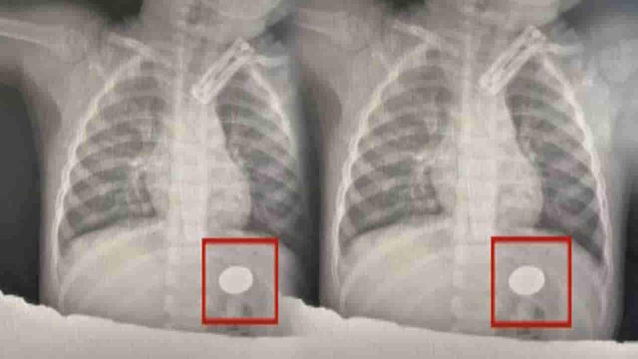 Viral: ఏడాదిన్నర చిన్నారికి తీవ్రమైన జ్వరం, దగ్గు.. టెస్టులు చేయగా.. డాక్టర్లకు ఎక్స్‌రేలో..