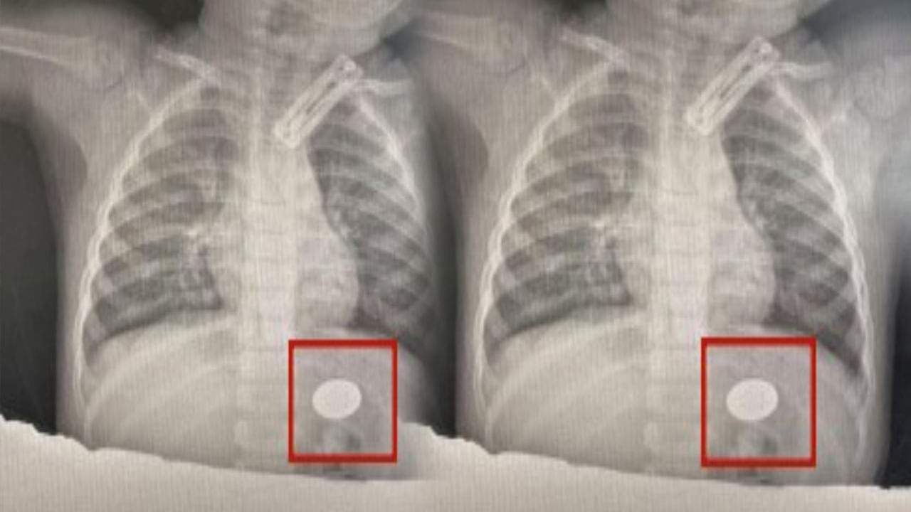 Viral: ఏడాదిన్నర చిన్నారికి తీవ్రమైన జ్వరం, దగ్గు.. టెస్టులు చేయగా.. డాక్టర్లకు ఎక్స్‌రేలో..