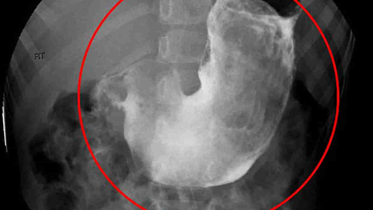 Viral: మహిళకు ఆగకుండా వాంతులు.. టెస్టులు చేయగా.. కడుపులో అడుగు పొడవైన